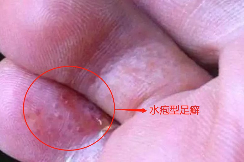 水疱型足癣