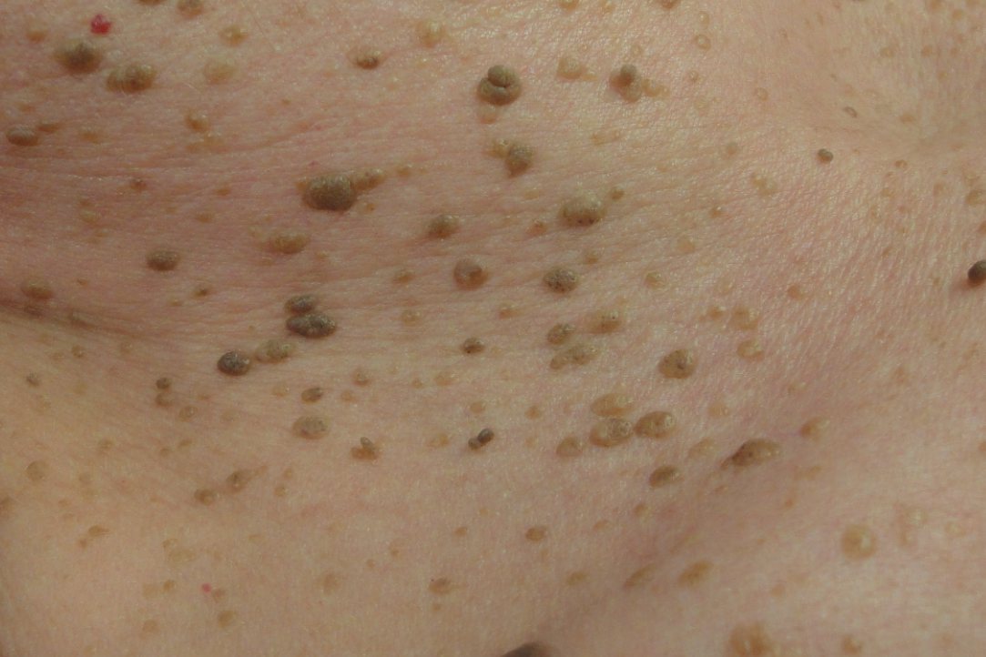 黑色丘疹性皮肤病