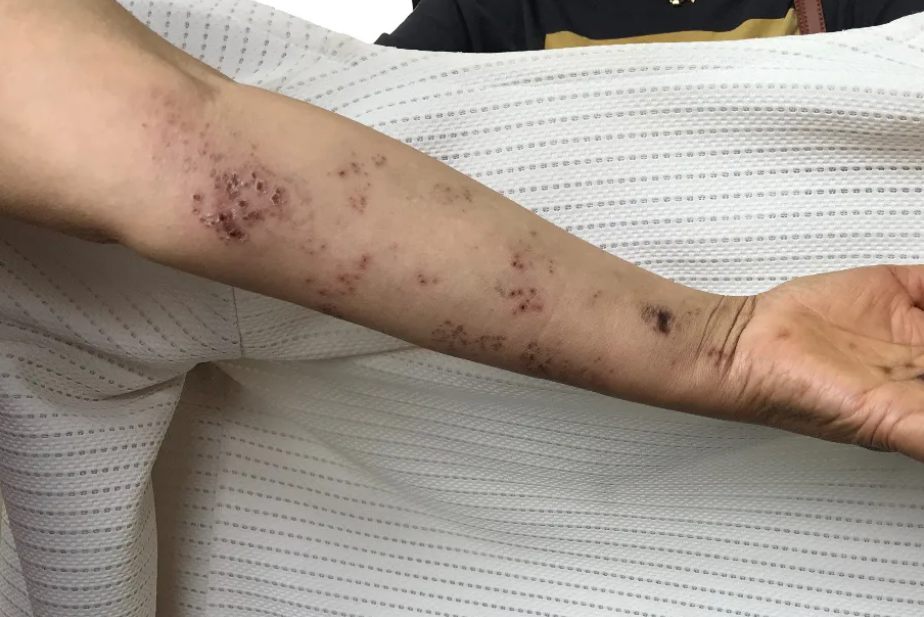 带状疱疹的晚期症状