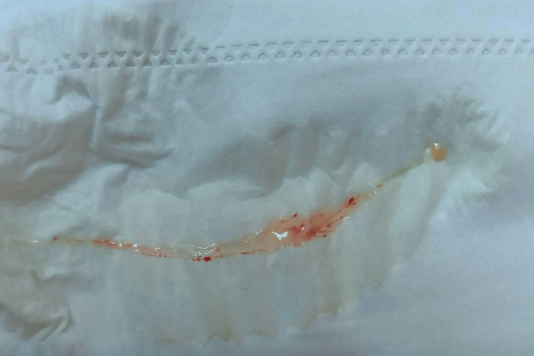 白带透明拉丝夹血丝