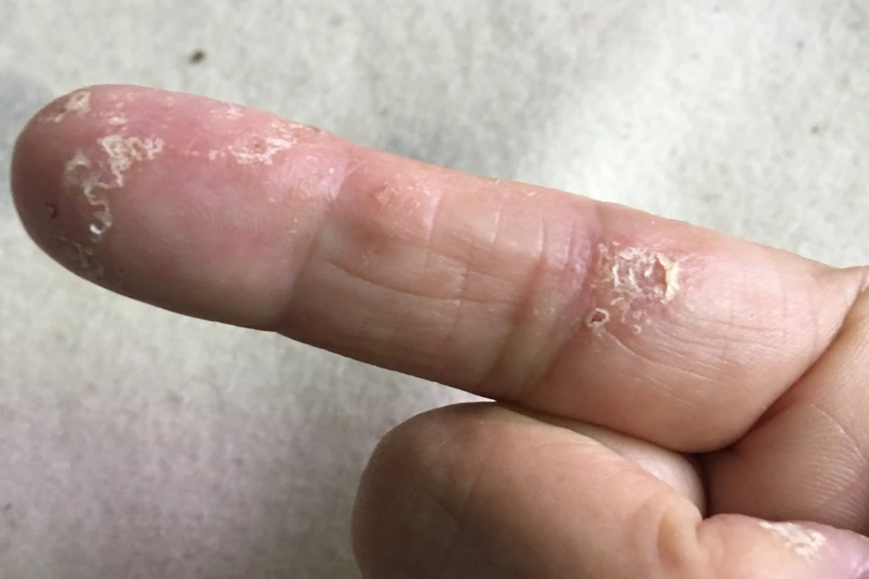 手指银屑病