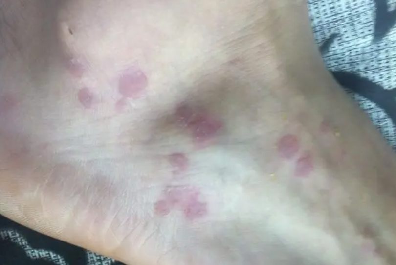 色素性扁平苔藓