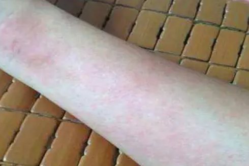 延迟性压力性荨麻疹