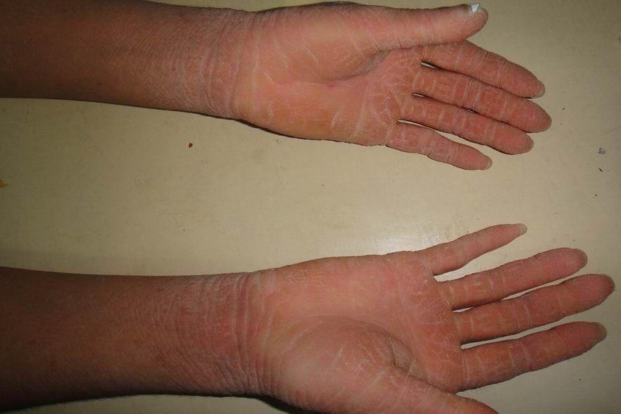 对称性肢端角化症