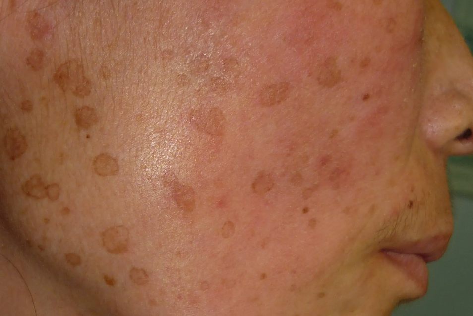 汗管角化症脸上斑