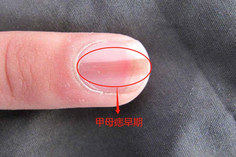 甲母痣早期图片