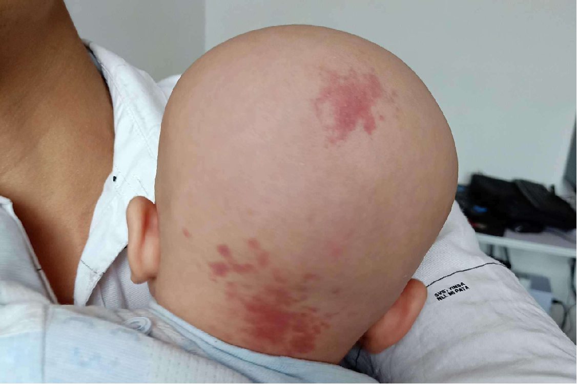 毛细血管胎记图