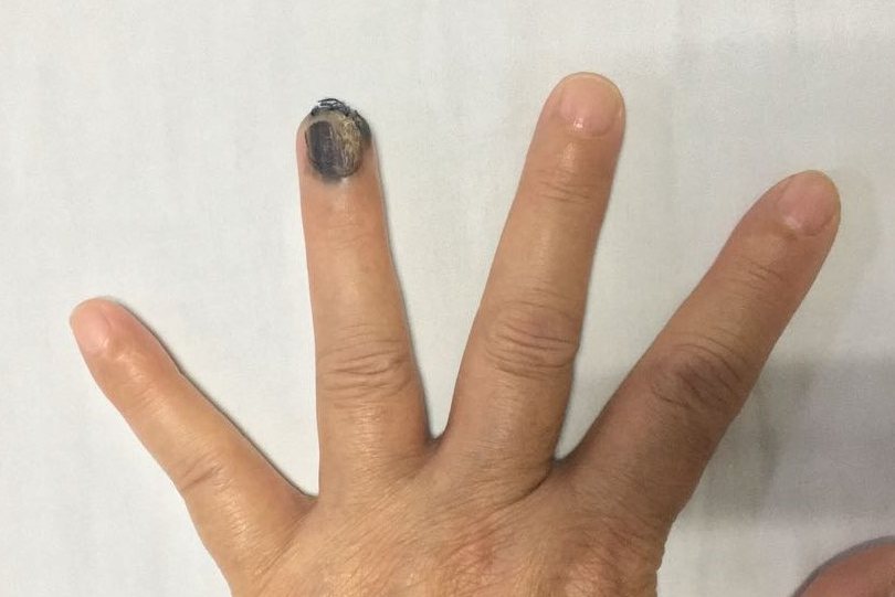 指甲黑色素瘤早期症状