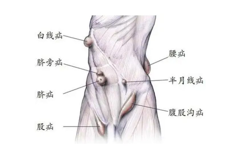 疝气示意图
