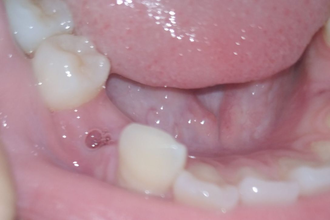 拔牙一个月后牙窝图片