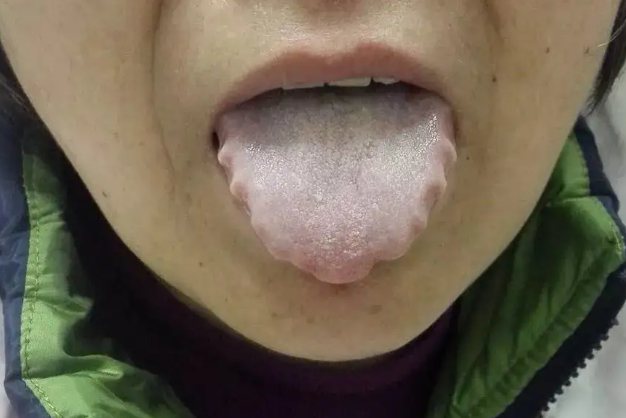 脾胃虚弱者舌头