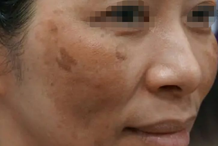 治疗后整体肤色