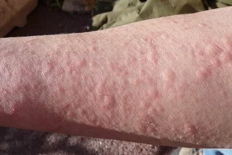 虫咬性荨麻疹
