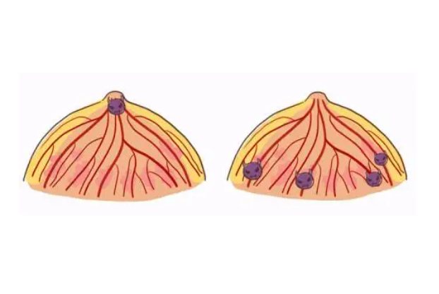 乳腺导管内乳头状瘤