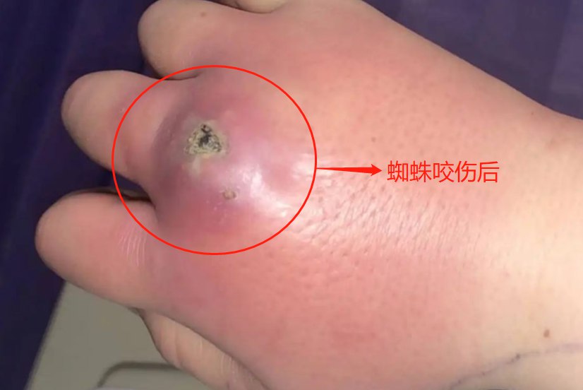 蜘蛛咬伤后图片
