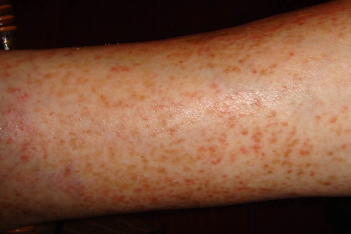 小腿过敏性皮炎