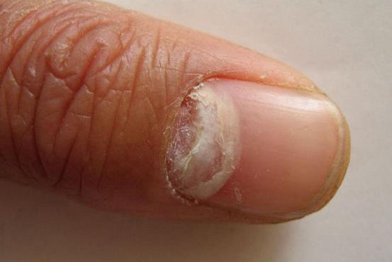 浅表性白色甲癣