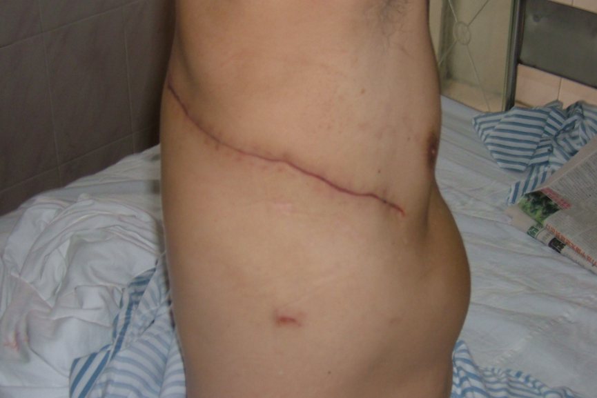 开胸手术疤痕