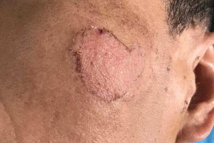 白斑移植手术20天图片