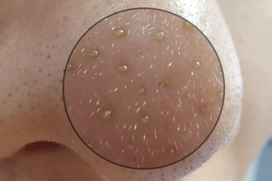 鼻子两侧挤出来的螨虫图片