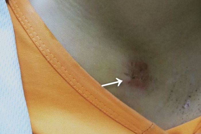 左边锁骨下方骨折