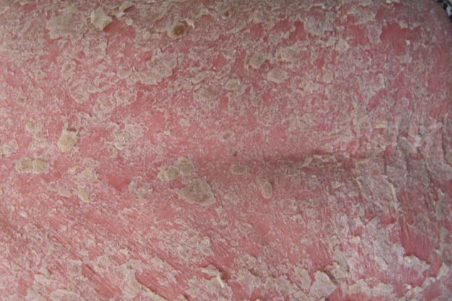 红皮病型银屑病