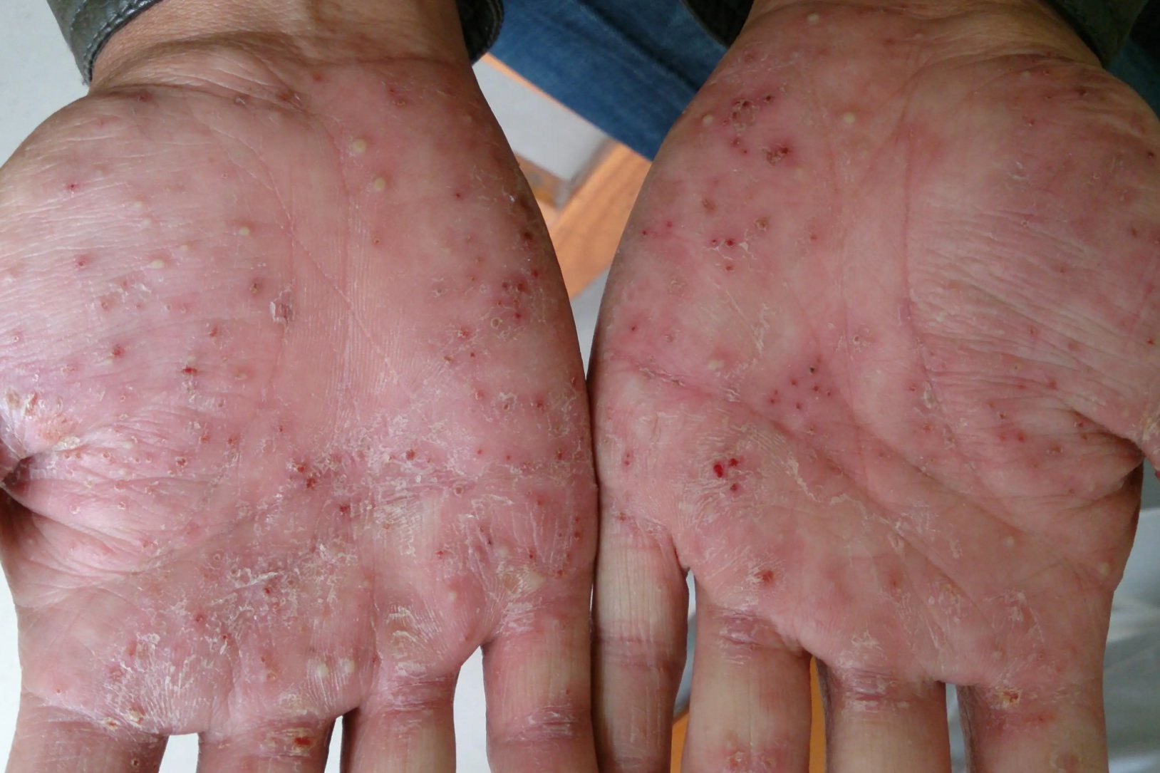 急性泛发性发疹性脓疱病