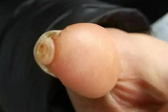 手指甲下的肉增生