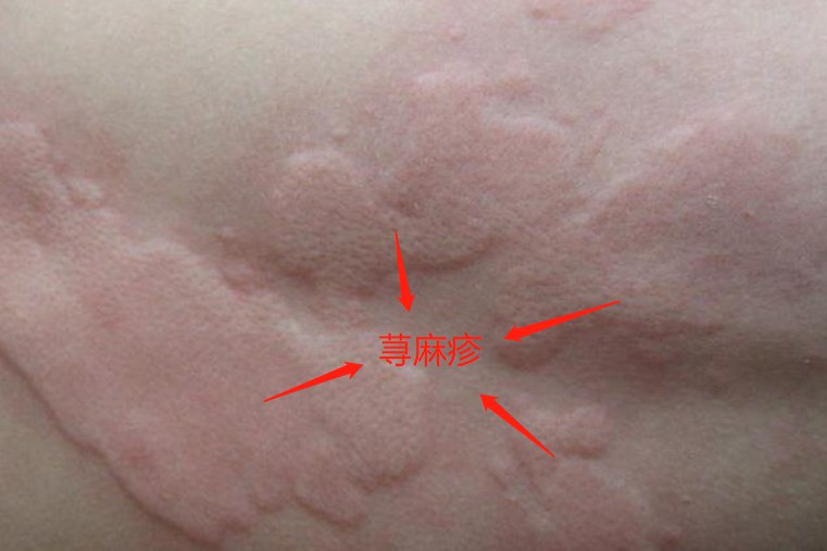 荨麻疹图片