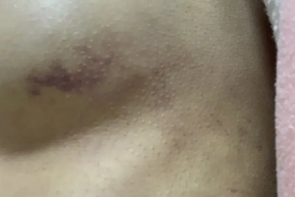 假体隆胸后淤青图片