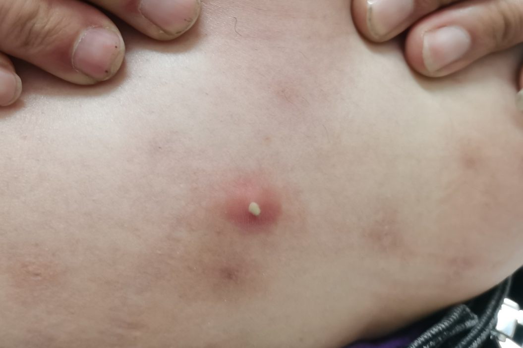 贝赫切特综合征