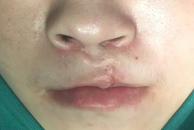 唇隐裂修复成功图