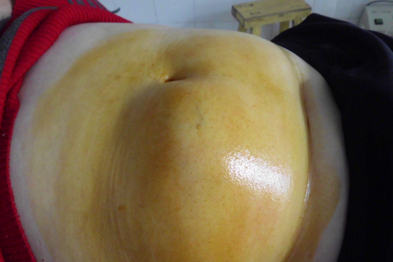 深部脂肪瘤