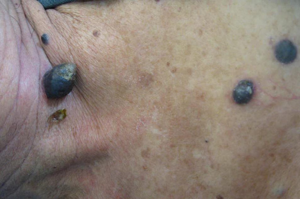 恶性黑色素痣
