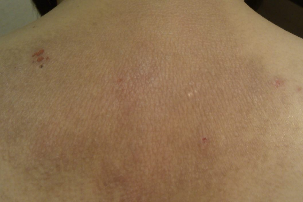 过敏性皮炎恢复期