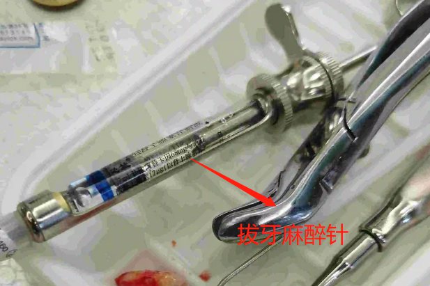 拔牙麻药针图片