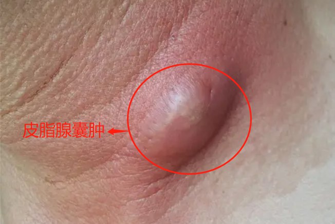 皮脂腺囊肿