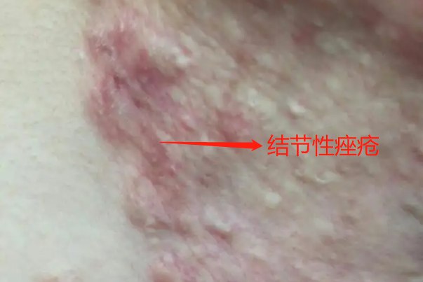 结节性痤疮