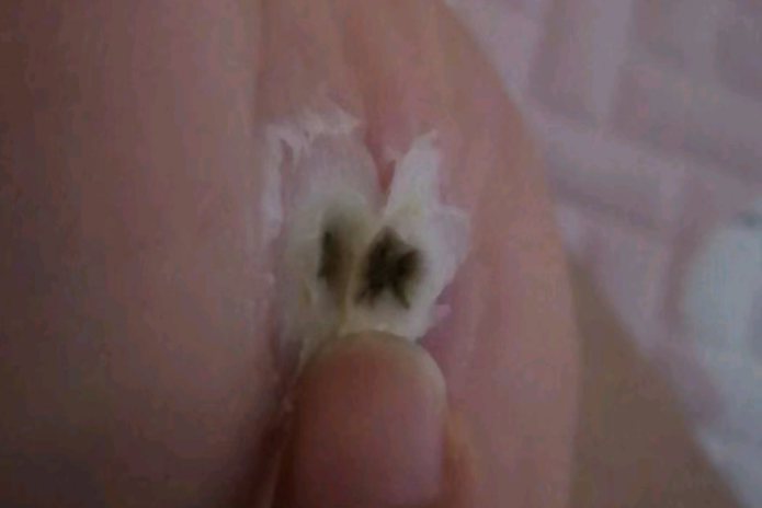 跖疣第一层死皮