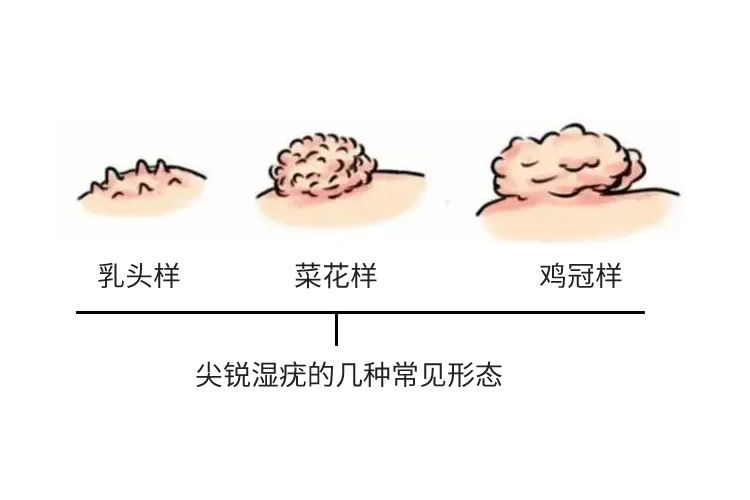 尖锐湿疣