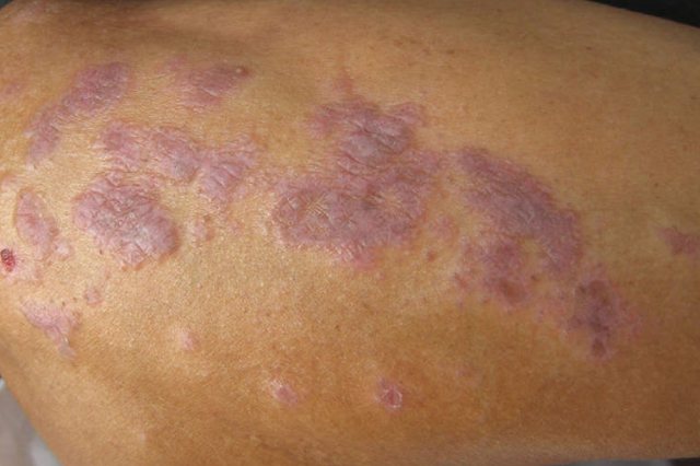 皮肤扁平苔藓病图片