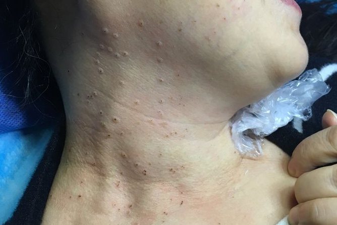 女性脖子上扁平疣