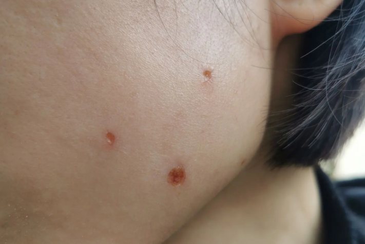 用白醋祛痣结痂