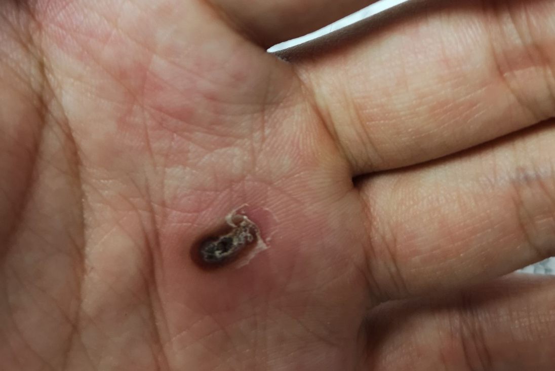 鸦胆子治疣涂10天图片