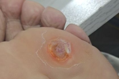 鸡眼治疗第十一天