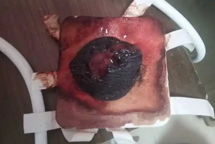 拔毒膏揭下来的图片