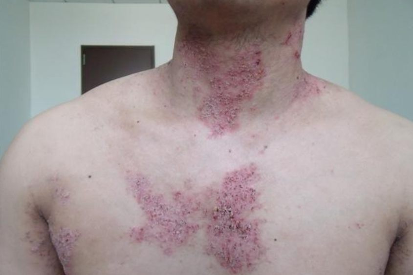 家族性良性慢性天疱疮