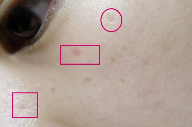 点痣后留下白印子图片