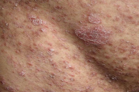 点滴状副银屑病