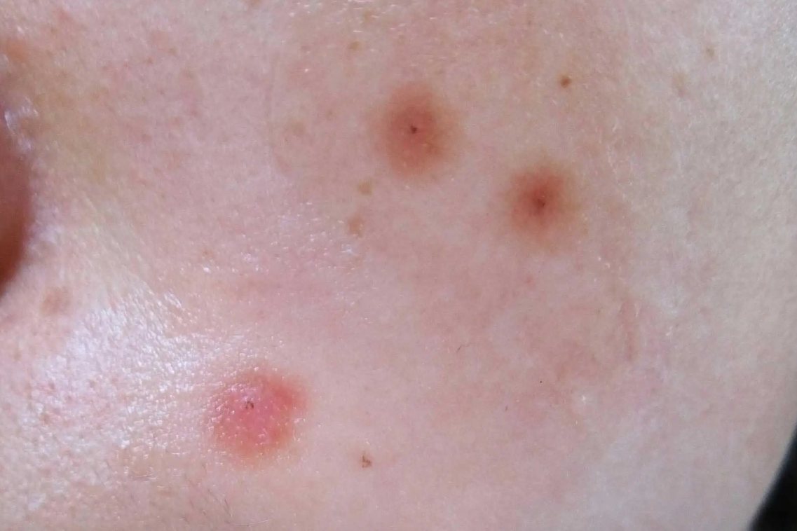 痦子去除后留疤